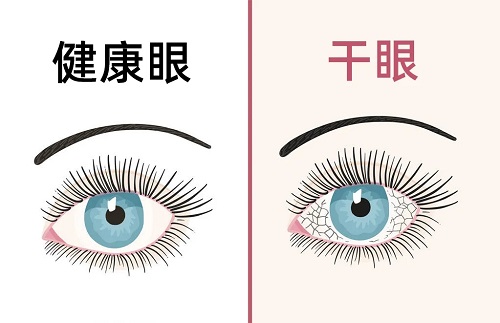 干眼怎么治疗好？